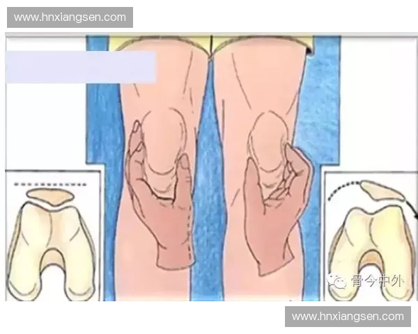 全面提升膝关节功能的科学化与个性化康复训练综合策略深度探索新 全面提升膝关节功能的科学化与个性化康复训练综合策略深度探索新
